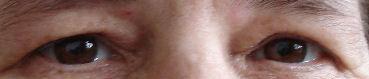 Augen Behandlung mit DoIn geschwollene Augen